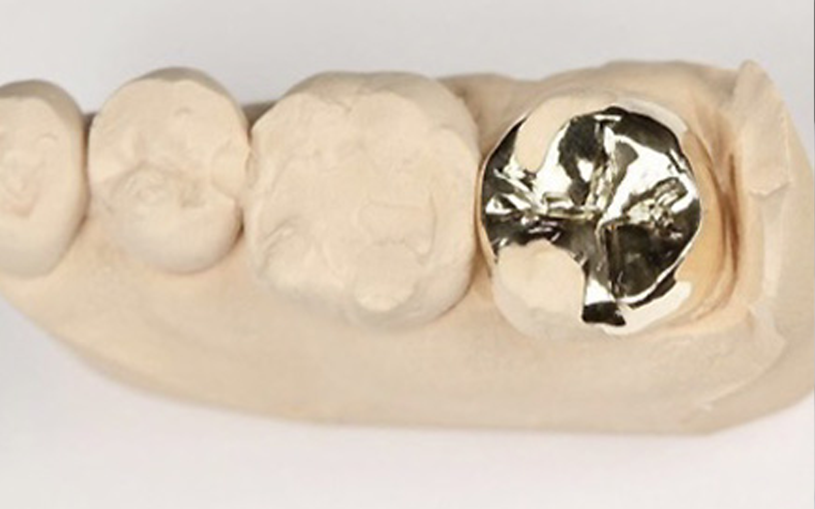 ゴールドインレー