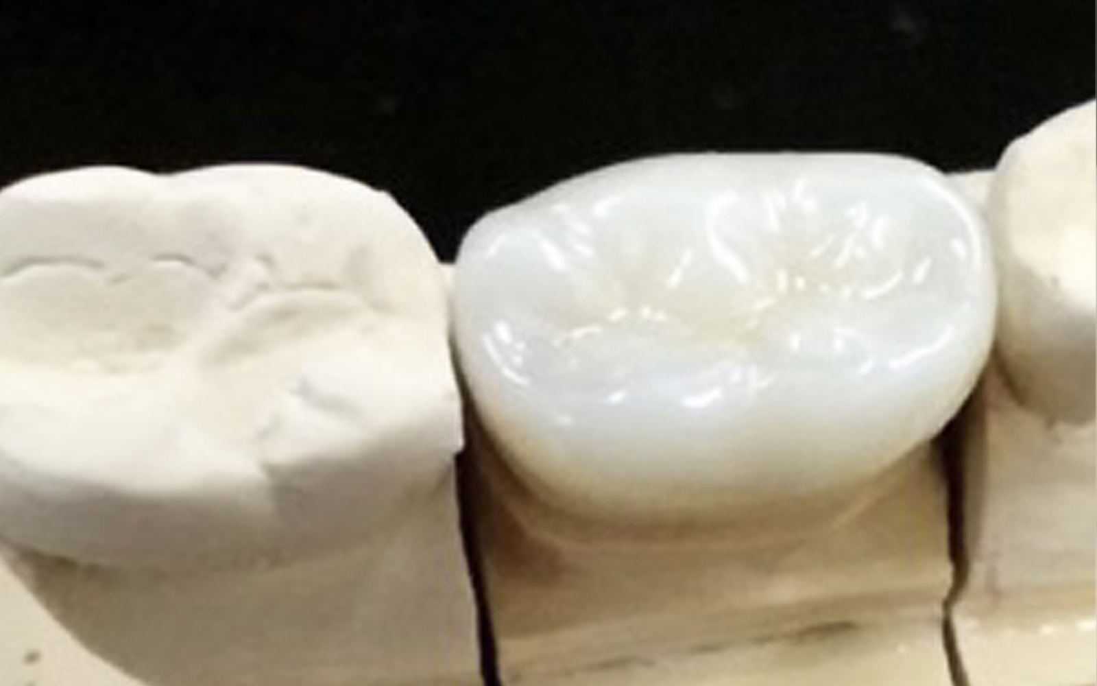 ジルコニアクラウン