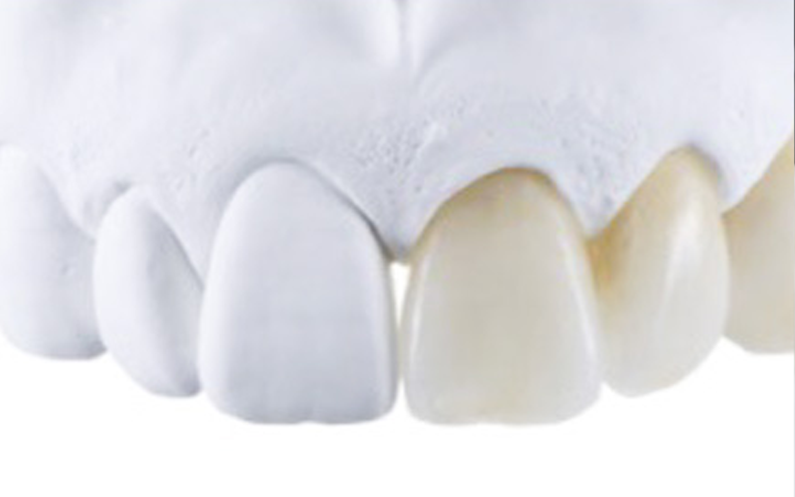 ジルコニアボンドクラウン