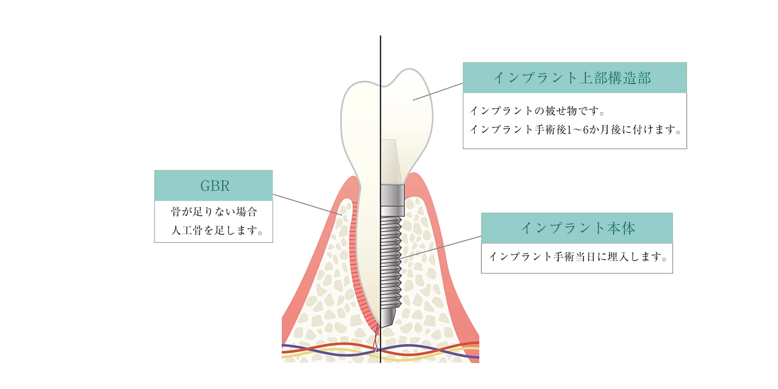 インプラントの構造