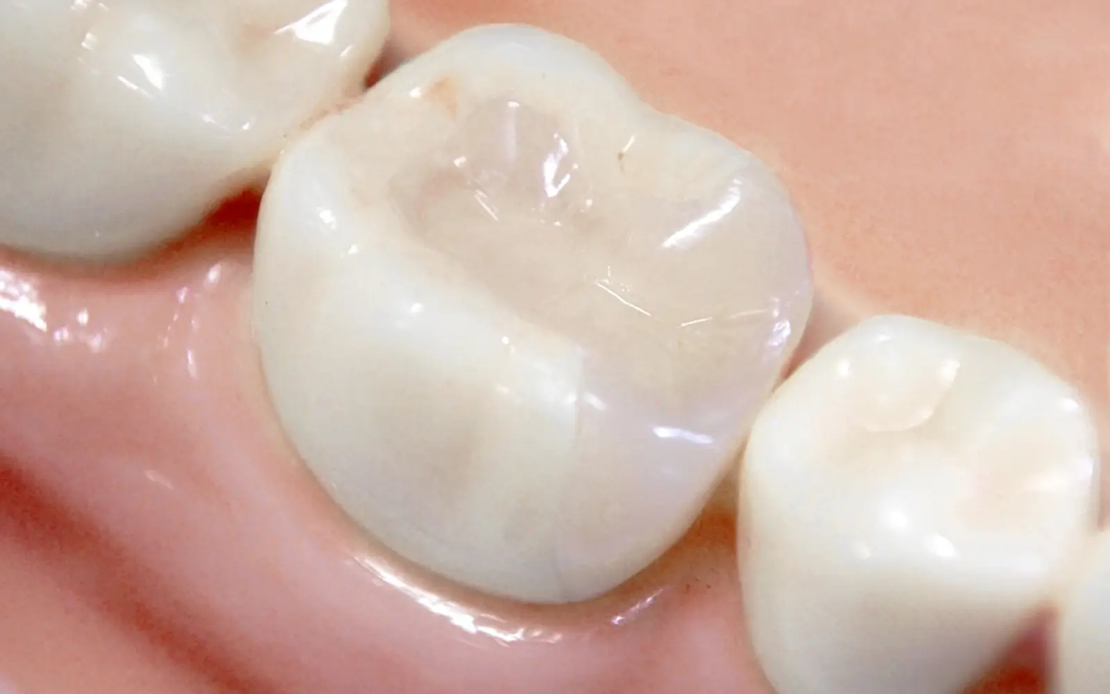 セラミックインレー：透明感を重視する詰め物の選択肢