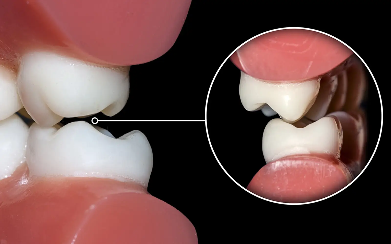 ナイトガードによる歯ぎしり・食いしばりの対策