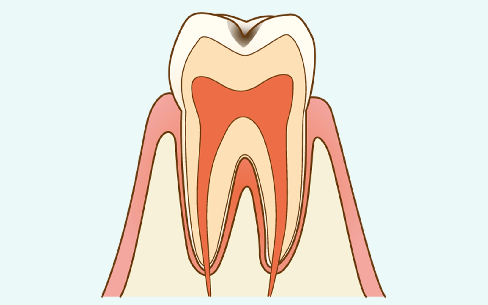 C1：エナメル質に小さな穴が生じるが、1回で修復できる段階