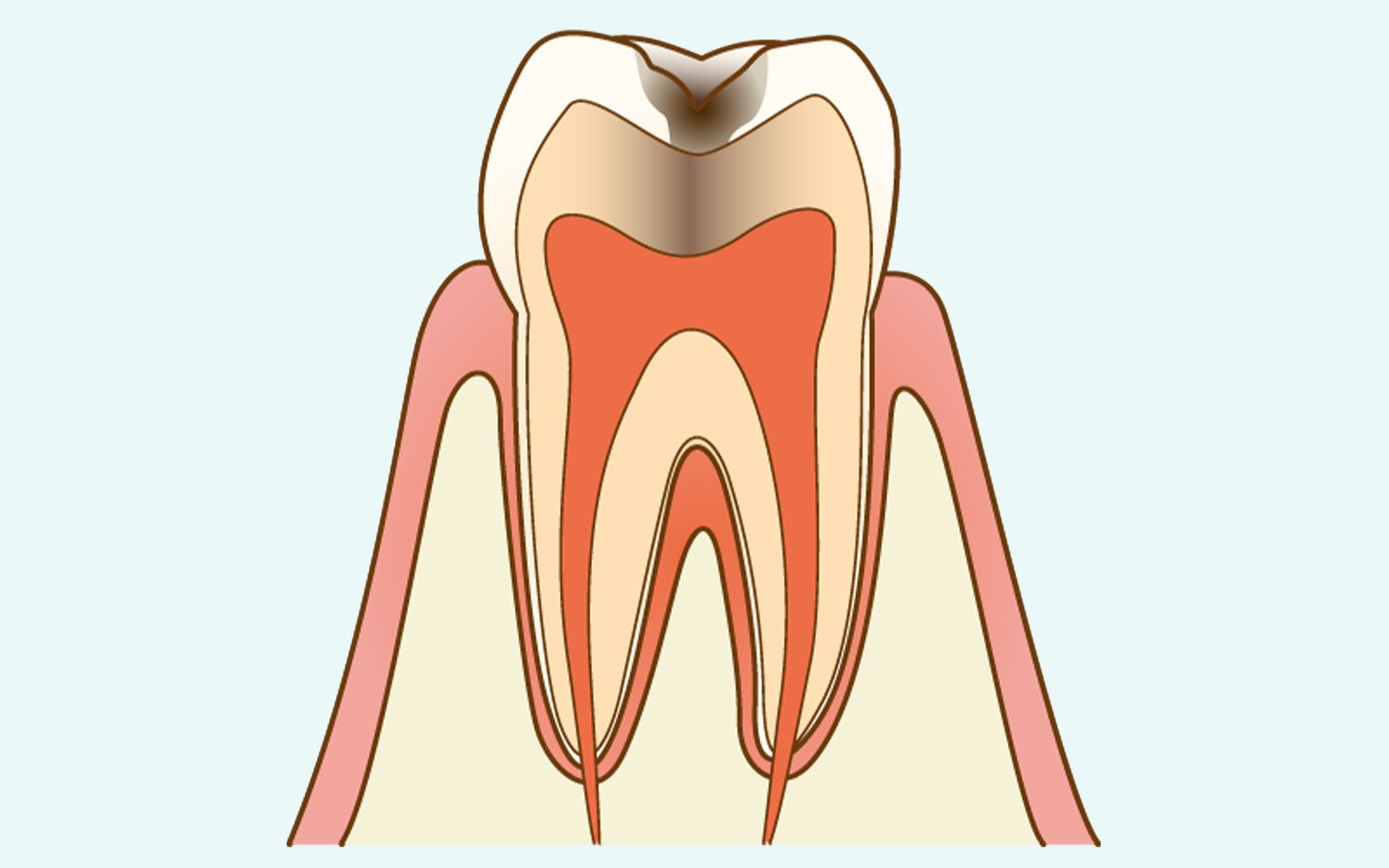 C2：象牙質まで侵食が進み、明確な痛みが出始める段階