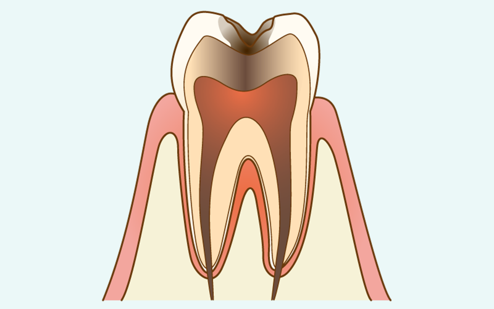 C3：神経まで達し、自発痛と根管治療が必要になる段階