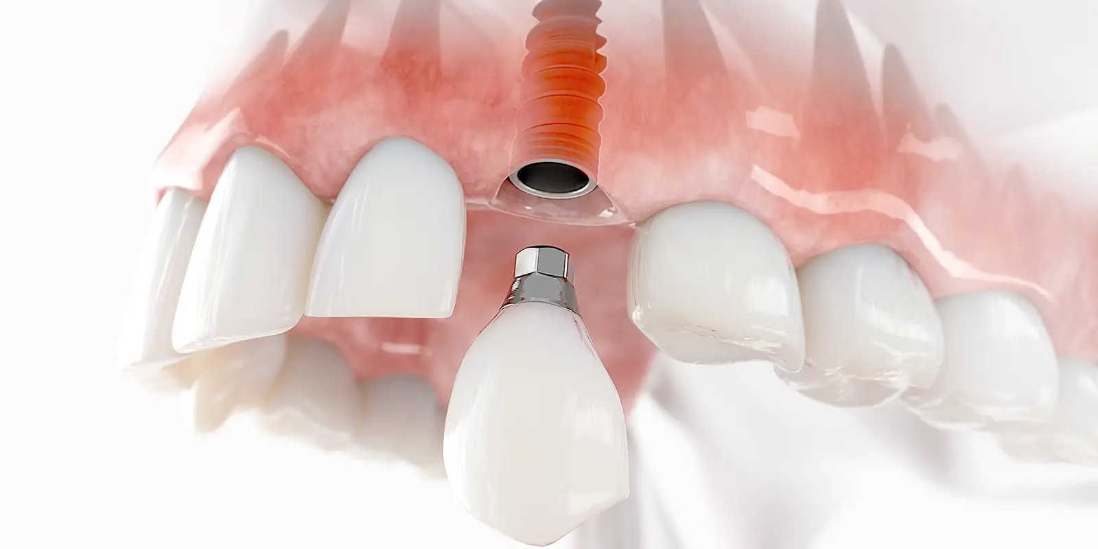 インプラントの構造と、天然歯に近い機能を発揮できる理由