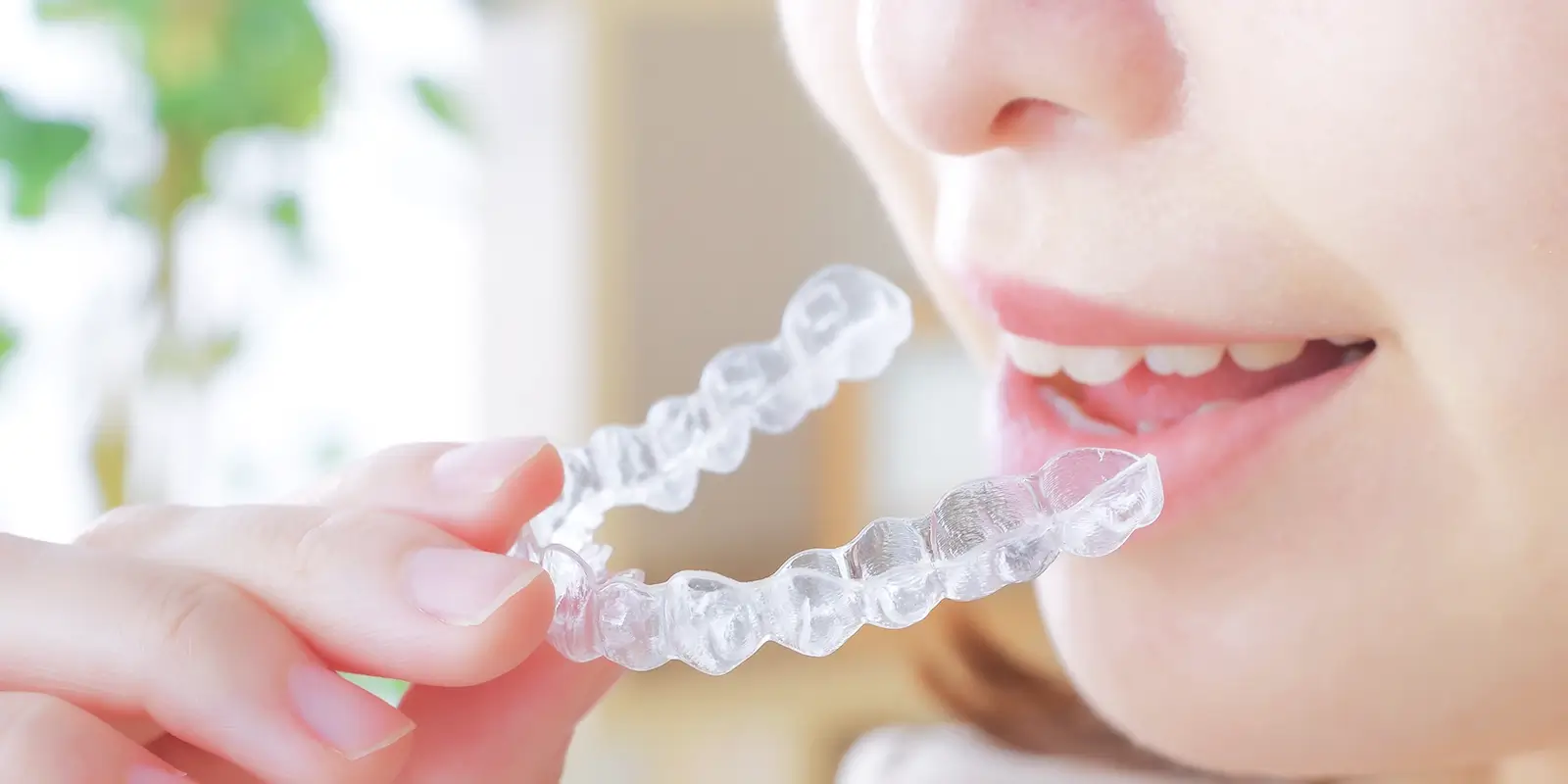 インビザラインで歯が動く仕組みワイヤー矯正との根本的な違い