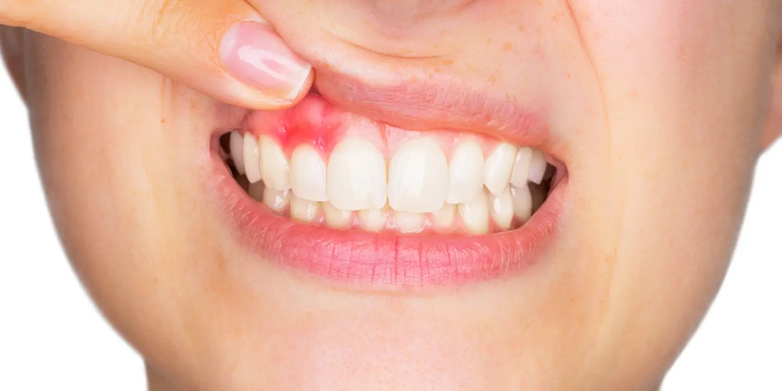 歯周病が進行する仕組みと、なぜ気づいたときには遅いのか