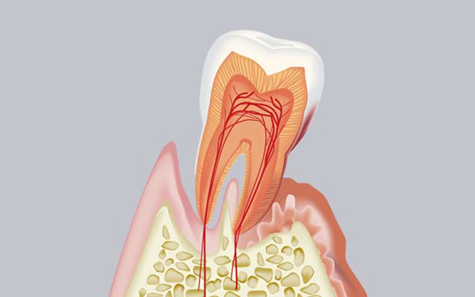 重度歯周炎（歯槽膿漏）