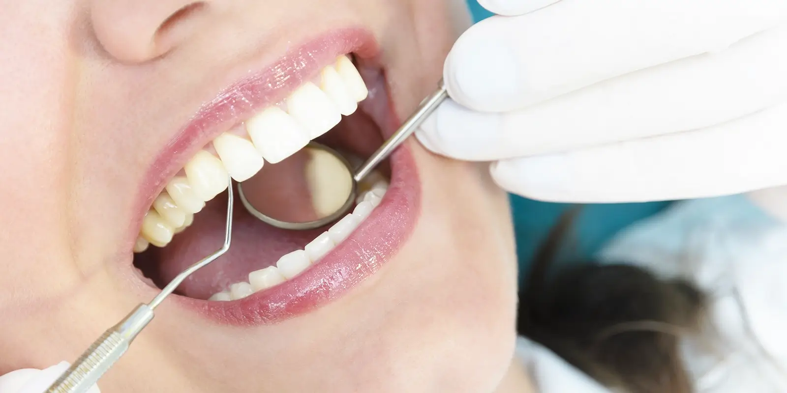 セルフケアだけでは防げない理由と、歯科医院での予防が必要なわけ