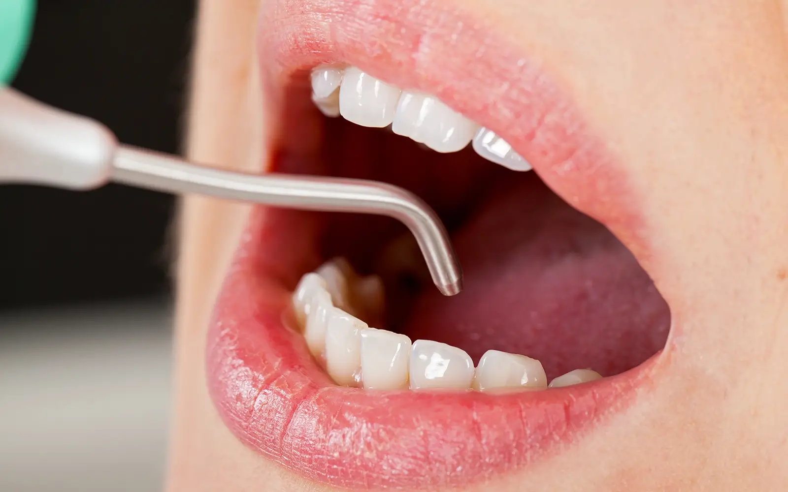 歯科医院のクリーニングがセルフケアと根本的に違う理由