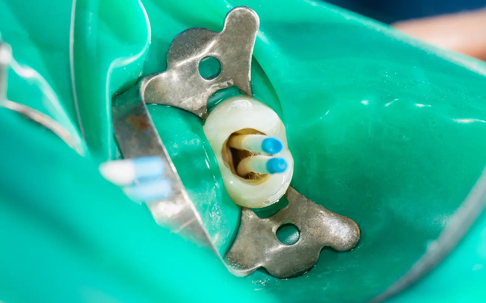 唾液の侵入を防ぐラバーダムの装着の重要性