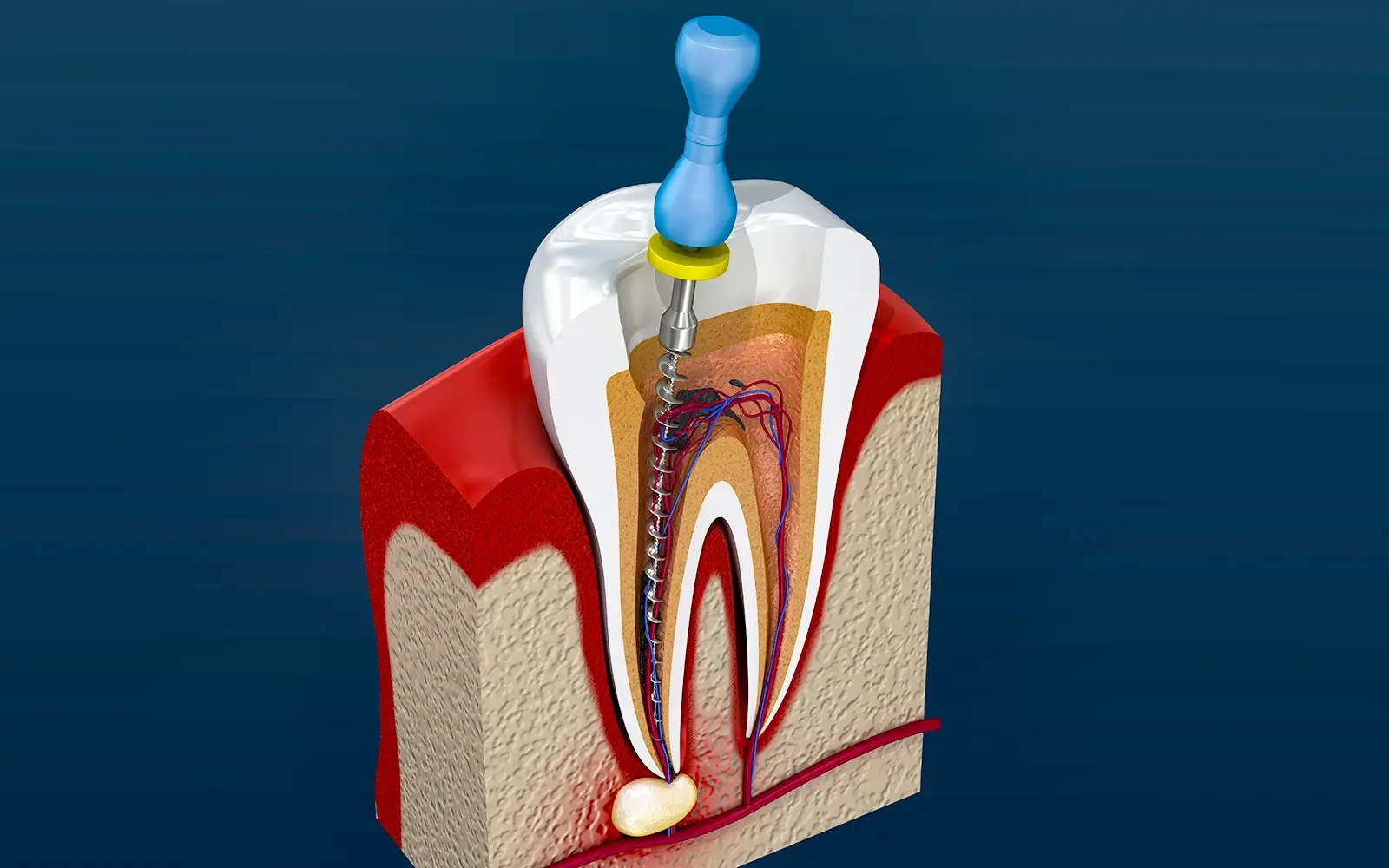 マイクロスコープで根管の隅々まで精密に清掃する
