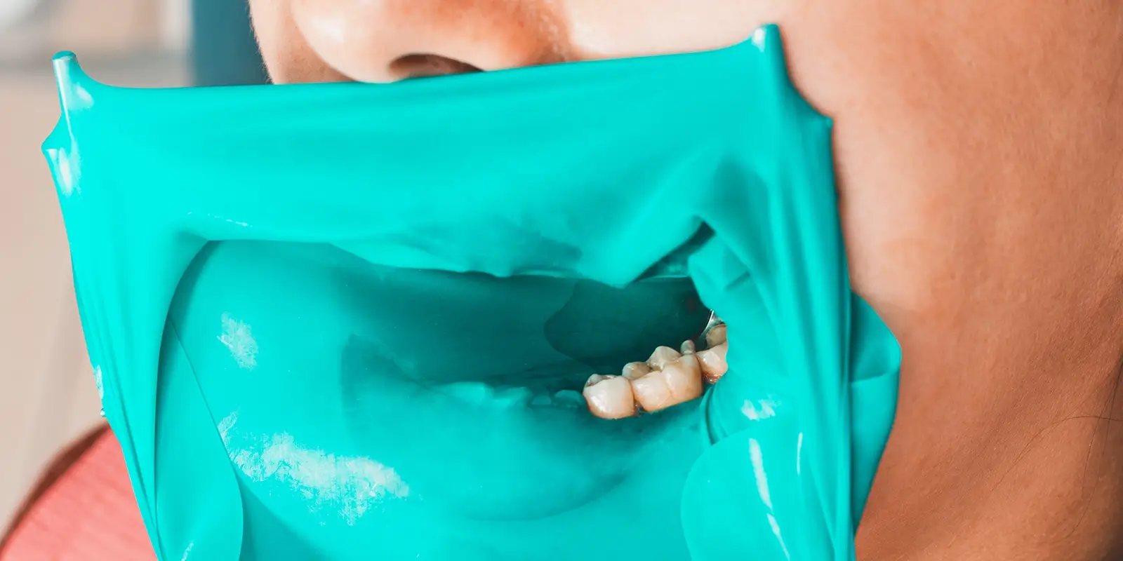 ラバーダムで治療中の無菌環境を徹底する