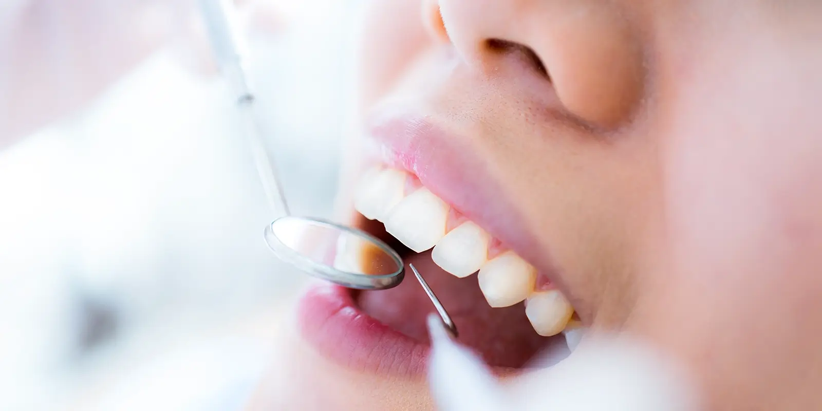 治療後のメインテナンスで根管治療の効果を長持ちさせる