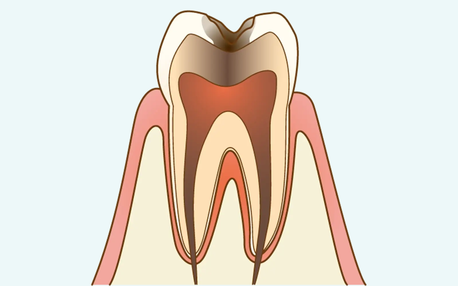 根管治療が必要な中〜重度の虫歯がある場合