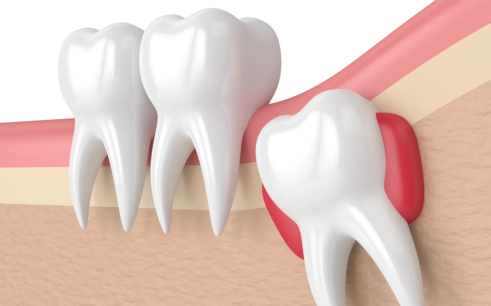 痛みと腫れの原因：智歯周囲炎とは